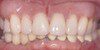 Smile Gallery Dr. Rubina Khorana DDS Bella Vista Smiles. Dental Emergencies, General, Cometic, Restorative, Preventative, Pediatric, Family Dentistry. Dentist in Lincoln, CA 95648