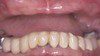 Smile Gallery Dr. Rubina Khorana DDS Bella Vista Smiles. Dental Emergencies, General, Cometic, Restorative, Preventative, Pediatric, Family Dentistry. Dentist in Lincoln, CA 95648